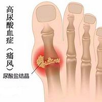 高尿酸血症(痛风)